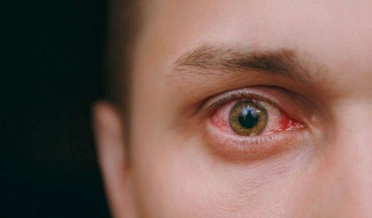 Penyakit Mata Merah Serang Warga Banyuwangi, Ratusan Orang Terjangkit