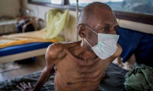 Penderita TBC di Sidoarjo Meningkat, Begini Upaya Penanganan Dinas Kesehatan 
