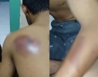 Santri Gresik Diduga Jadi Korban Perundungan Rekan Sesama Ponpes, Punggung Alami Luka Bakar